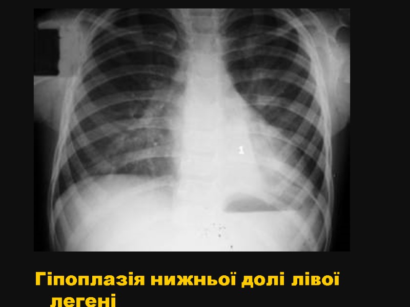 Гіпоплазія нижньої долі лівої легені
